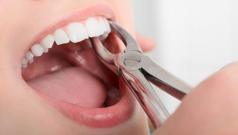 видалення зубів
