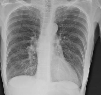 1. Хронічні обструктивні захворювання легень