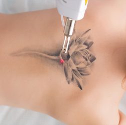 Современные лазеры для удаления тату и татуировок