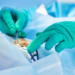 Лікар проводить операцію на оці