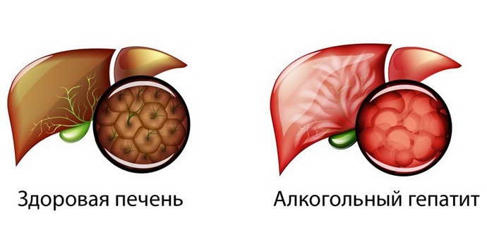 Алкоголь і його вплив на печінку