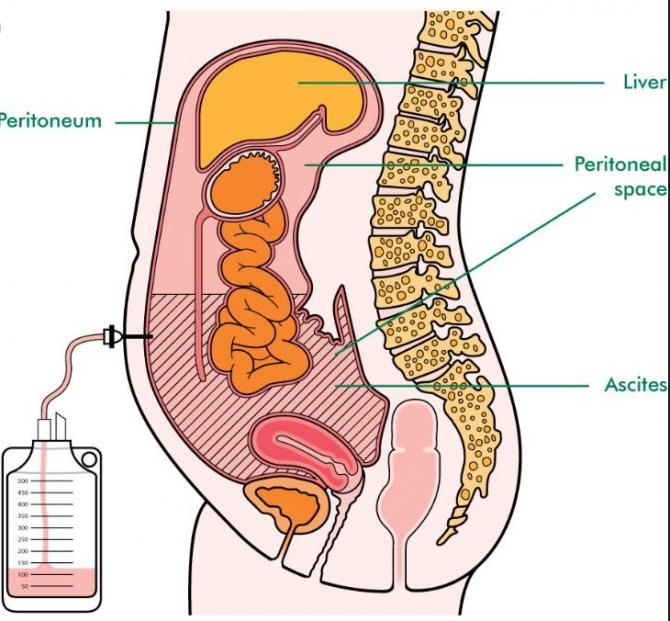 Лапороцентез. Диагностическая пункция брюшной полости. Асцит прокол брюшной полости. Асцитическая жидкость в брюшной полости. Пункция жидкости брюшной полости.