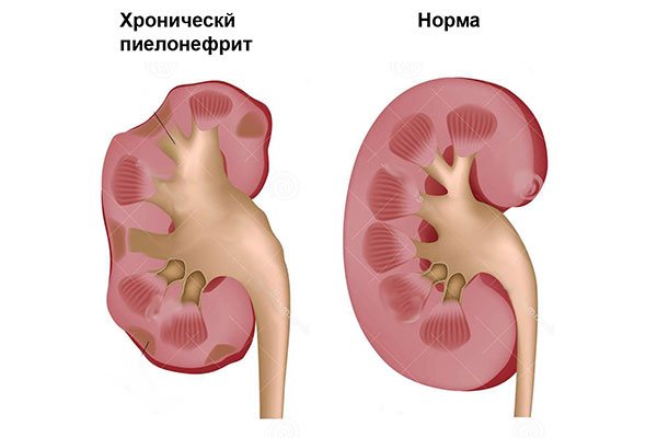 Болить у правому боці після алкоголю