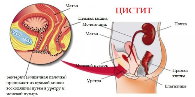 Цистит після прийому алкоголю