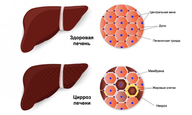 Декомпенсований цироз печінки