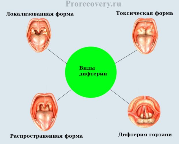 Осложнения дифтерии. Субтоксическая дифтерия. Токсическая дифтерия зева симптомы. Локализованная форма дифтерии ротоглотки. Локализованная форма дифтерии зева.