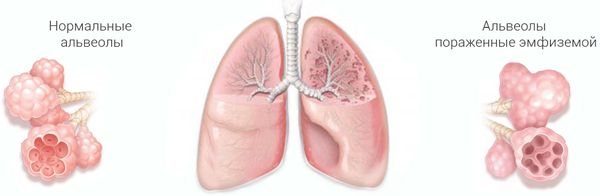 емфізема легенів
