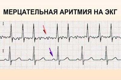 Якщо прискорене серцебиття з похмілля