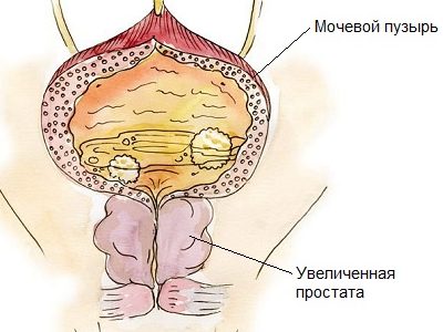 гіперплазія простати