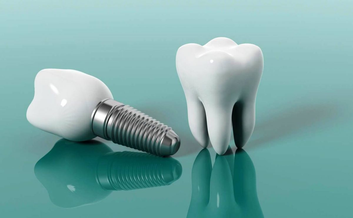зубний імплант