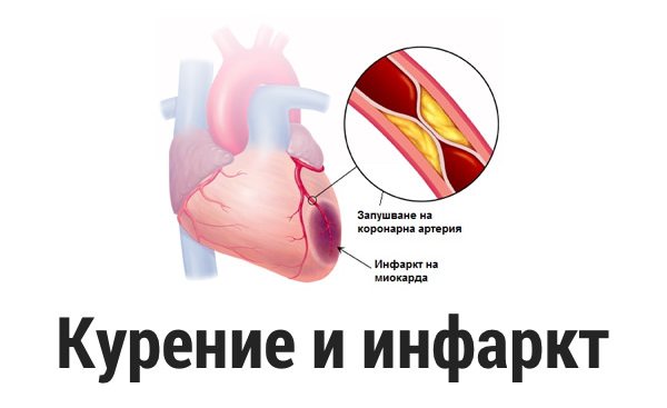 Інфаркт міокарда