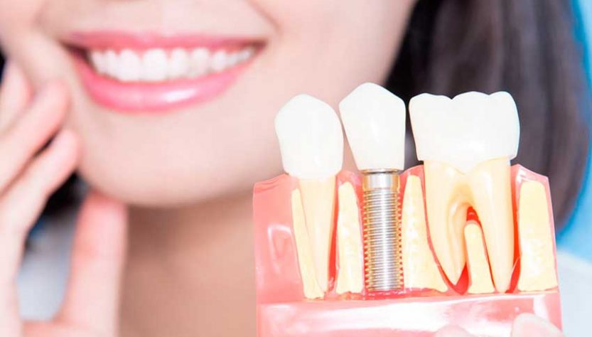 Имплантация поможет решить проблему с выпавшими зубами
