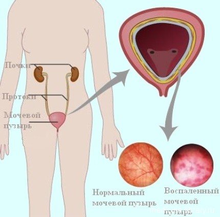 Чи можна пити алкоголь при циститі: рекомендації