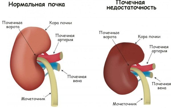 Німесил (Nimesil). Як приймати порошок, інструкція, аналоги, ціна