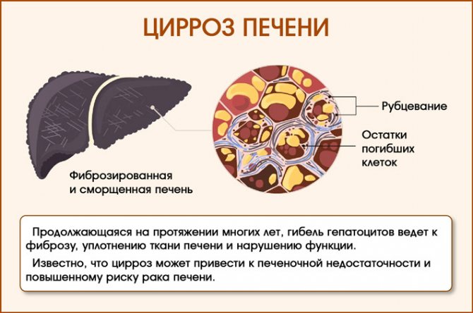 Печінка при цирозі