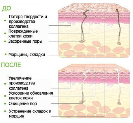 пілінг як проходить