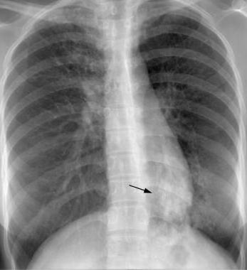 покаже чи рентген туберкульоз легенів