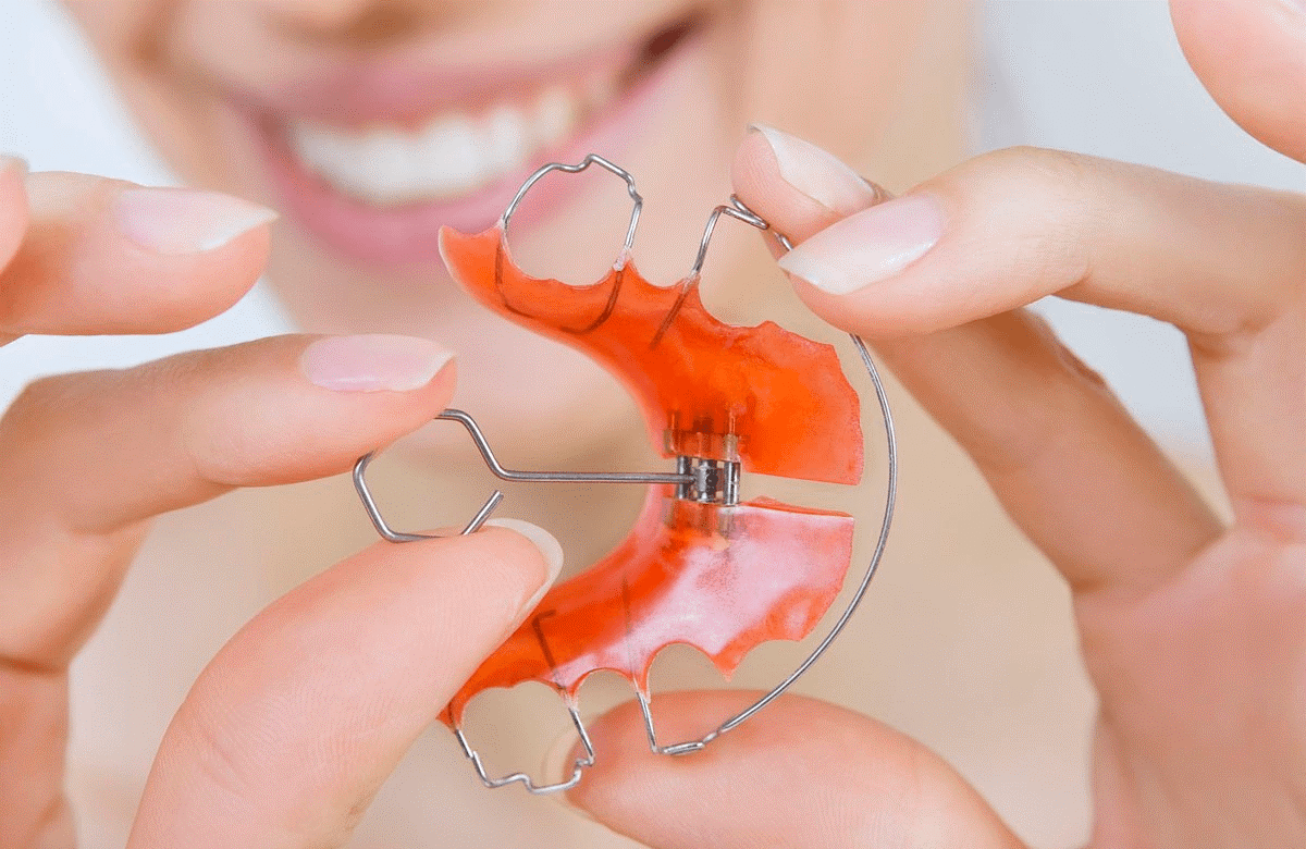 Ортодонтическая пластинка для прикуса