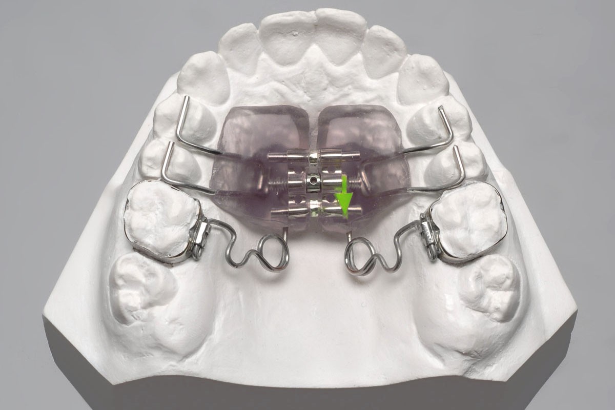несъемная ортодонтическая пластинка