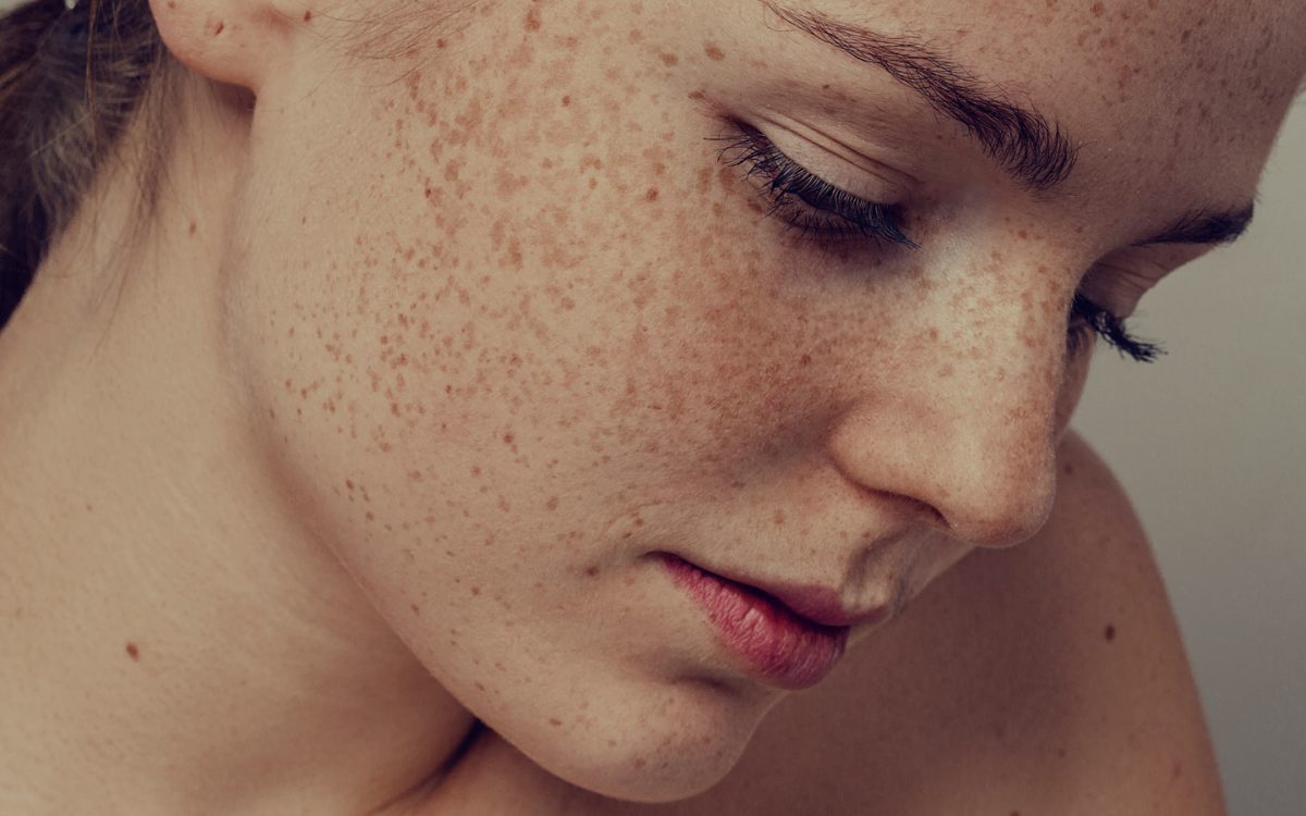 Гиперпигментация кожи лица