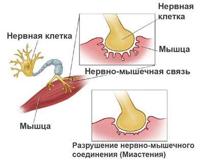 прояв міастенії