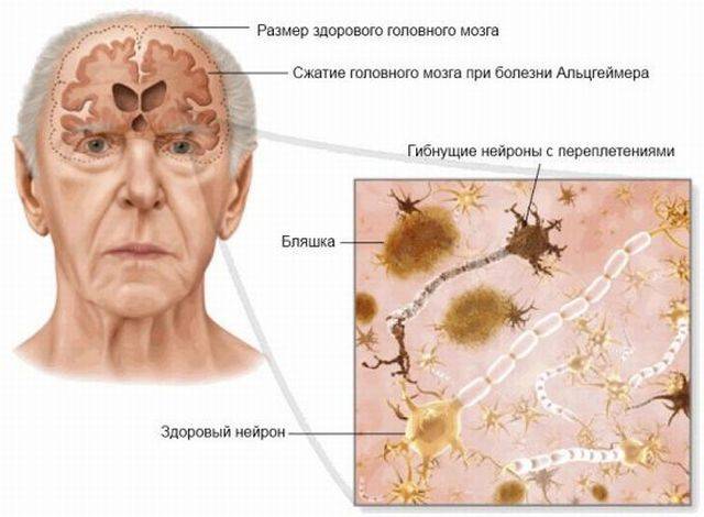 руйнування мозку при Альцгеймера