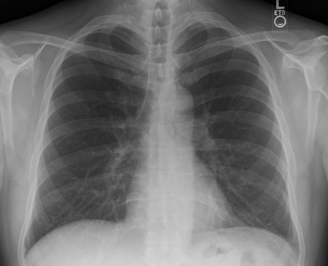рентгенограма легенів