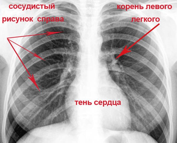 знімок легенів