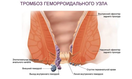 Тютюновий дим підвищує згортання крові, що загрожує тромбозом прямої кишки