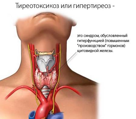 Тиреотоксикоз - можлива причина підвищеного потовиділення