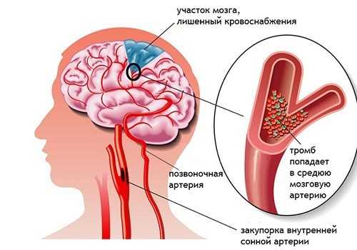 тромб в головному мозку