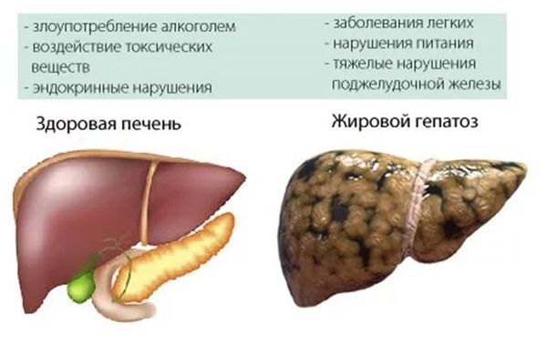 жировий гепатоз