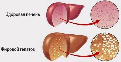 жировий гепатоз