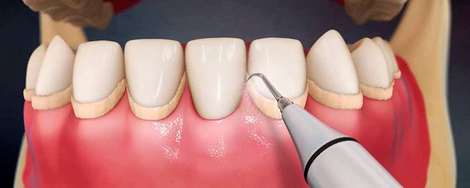 Процесс удаления зубного налета с помощью ирригатора